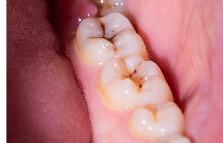 Intrinsic tooth discolouration