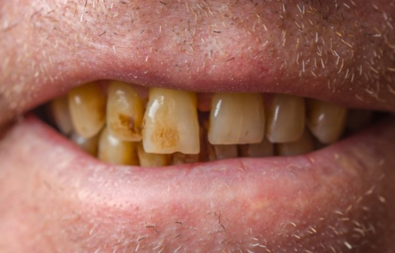 Tooth discolouration based on age